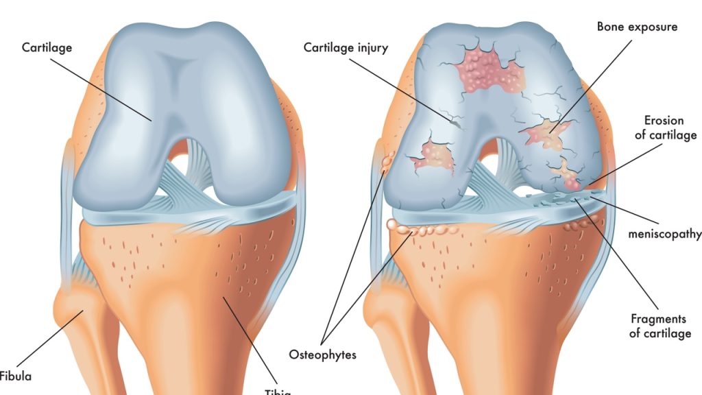Cartilage Defect Surgery in UK 1