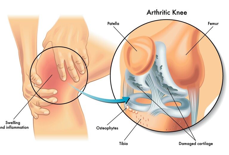 Cartilage Defect Surgery in UK 3