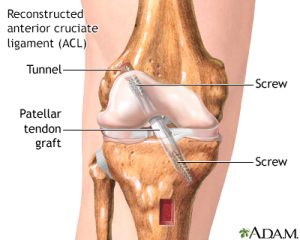 Cartilage Defect Surgery in UK