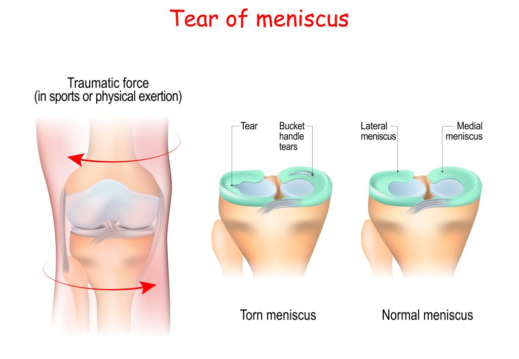 Expert Meniscus Surgery in UK