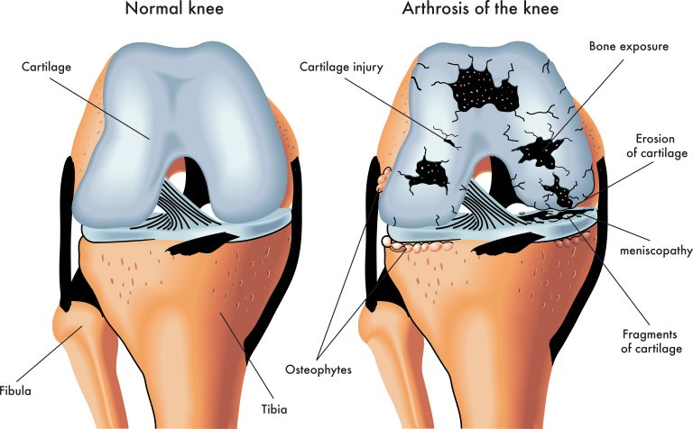 Rehabilitation for Arthritic Joints UK