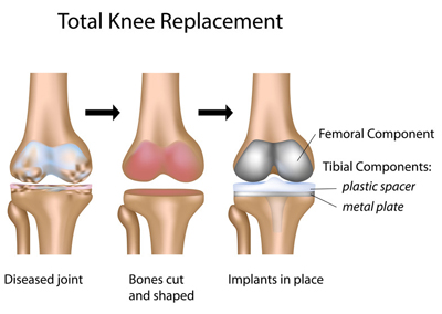 Expert Osteotomy Procedure in UK