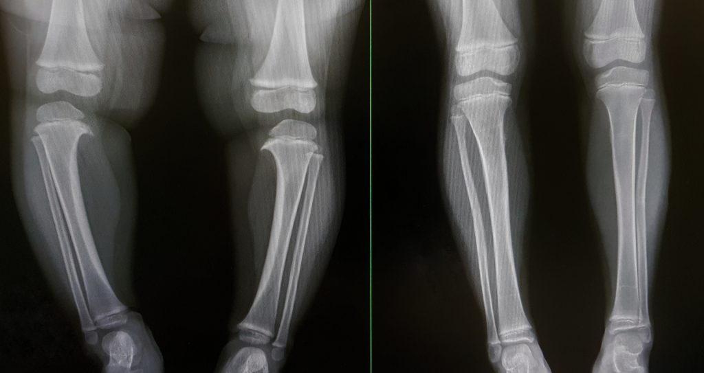 Expert Osteotomy Procedure in UK 1