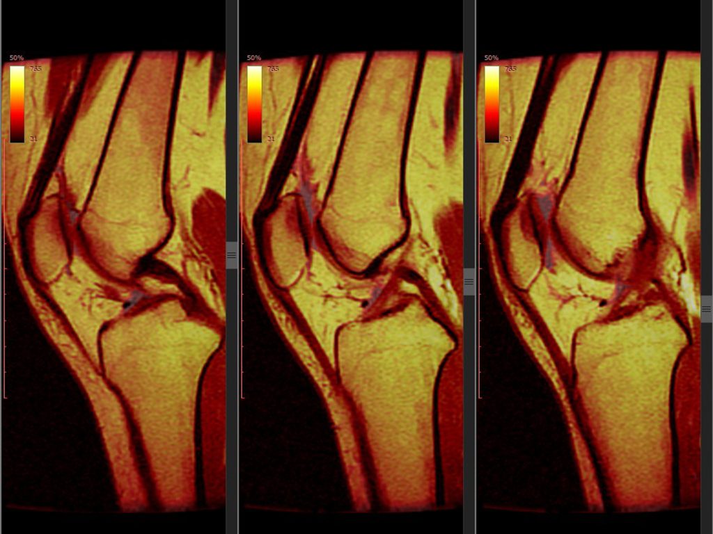 Expert Meniscus Surgery in UK